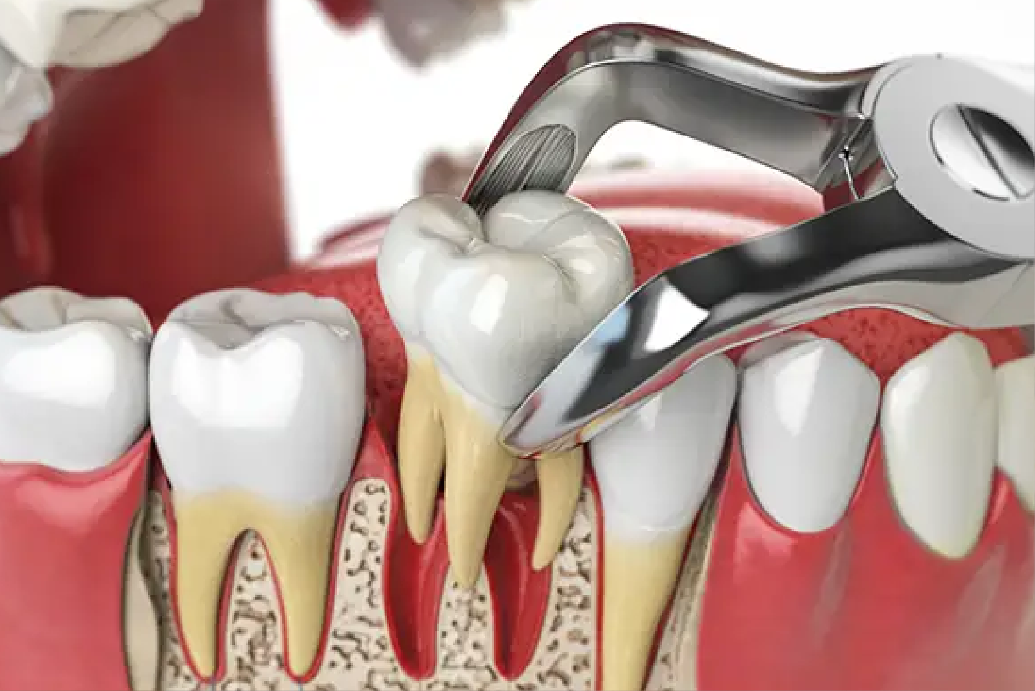 Dental Extractions